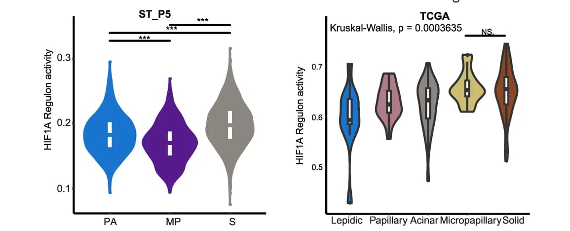 Open access visualization of Violin Plot, HIF1A Regulon, TCGA Cohort, Lepidic, Papillary