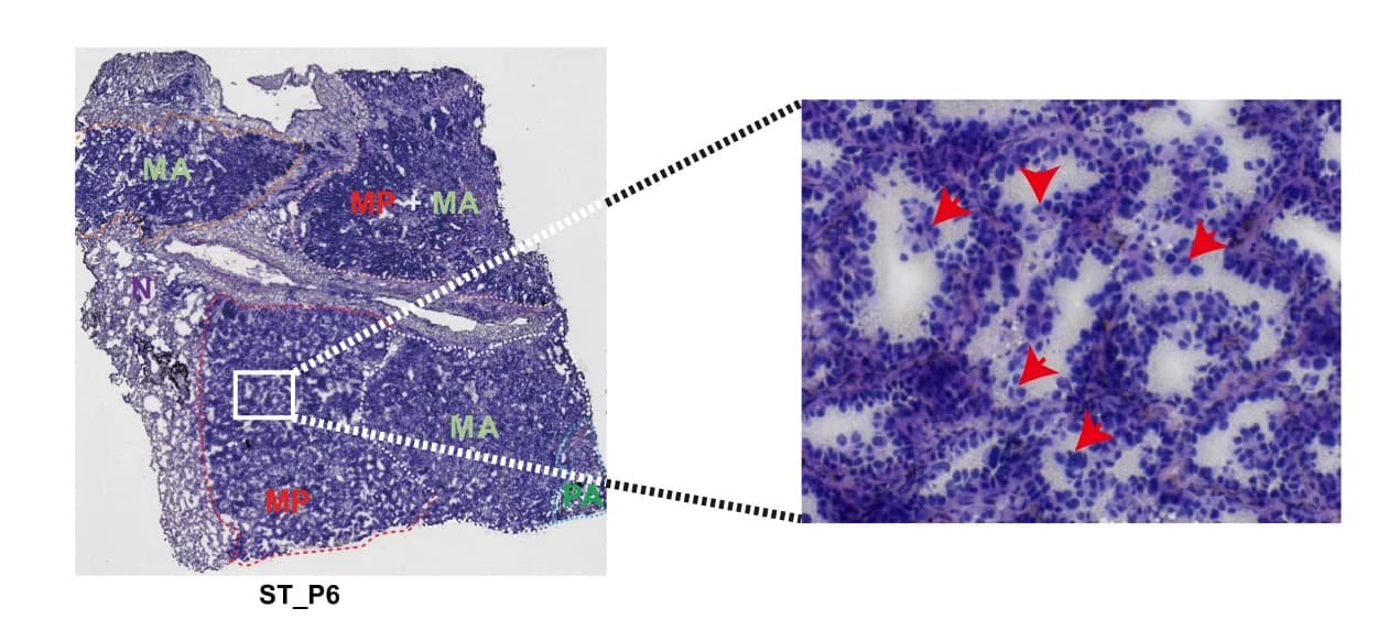 Open access visualization of Microscopy, MP Subtype, Micropapillary Tufts, ST_P6