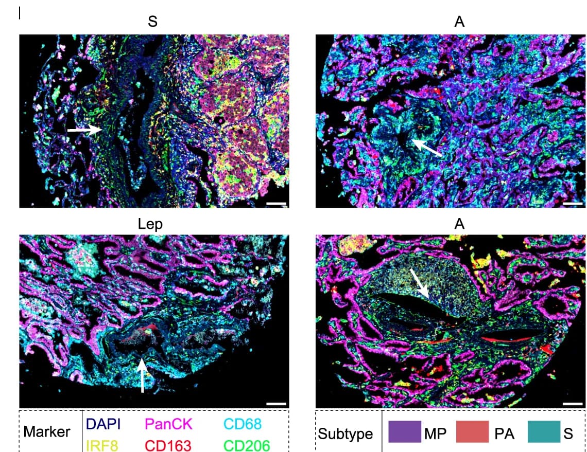 Open access visualization of Microscopy, CD68+ CD206+ Macrophages, Vessel Regions, DAPI, PanCK
