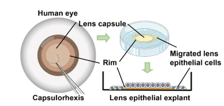Open access visualization of Workflow, Illustration, Primary Culture, Human Lens Epithelial Explant, Anterior Capsule