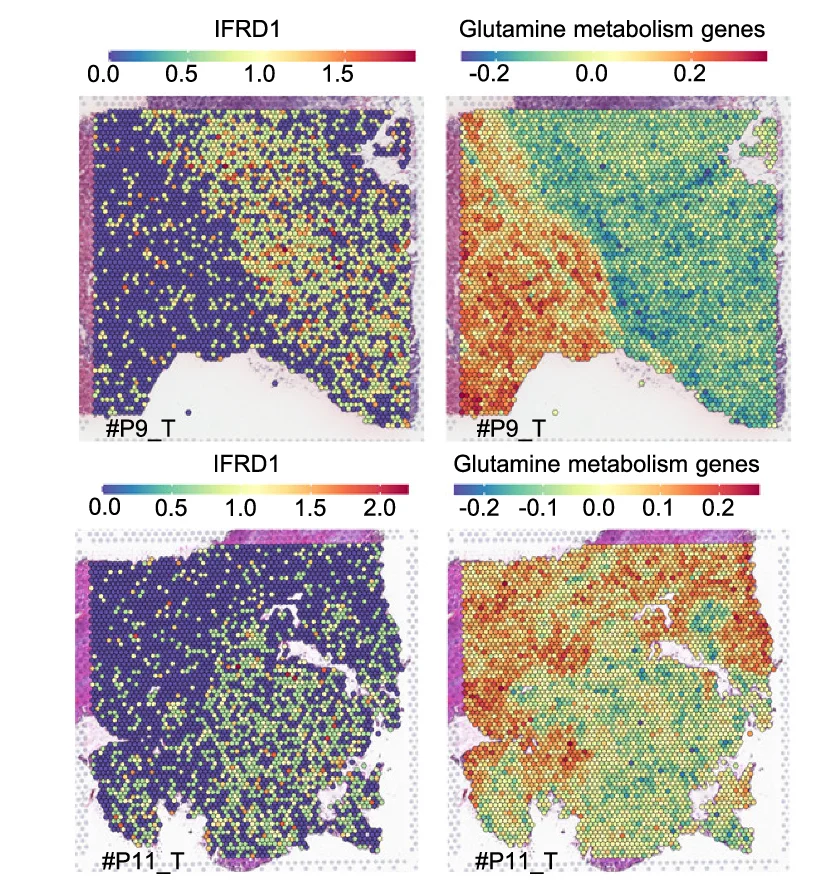 Open access visualization of Heatmap, Spatial Transcriptomics, IFRD1, Glutamine Metabolism-Related Genes, Tumor Tissues