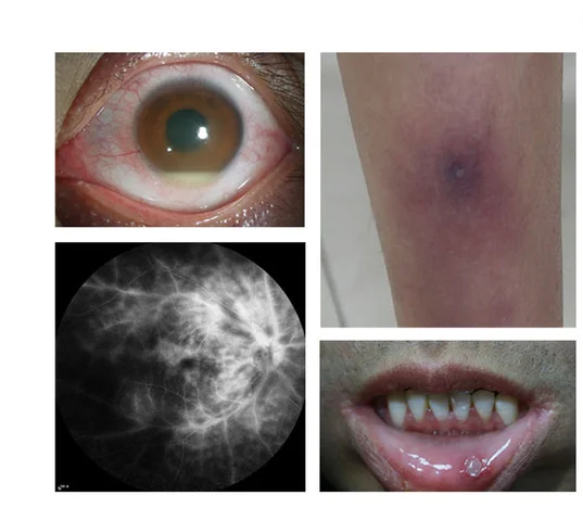 Open access visualization of Photo, Microscopy, Photograph, BU Manifestations, Hypopyon