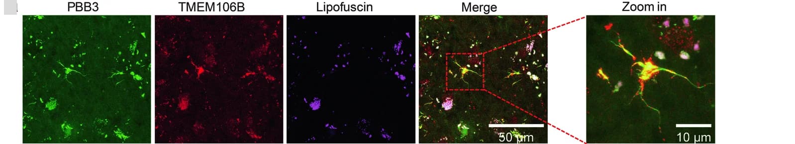Open access visualization of Microscopy, Immunofluorescent Staining, TMEM106B, PBB3, Temporal Cortex