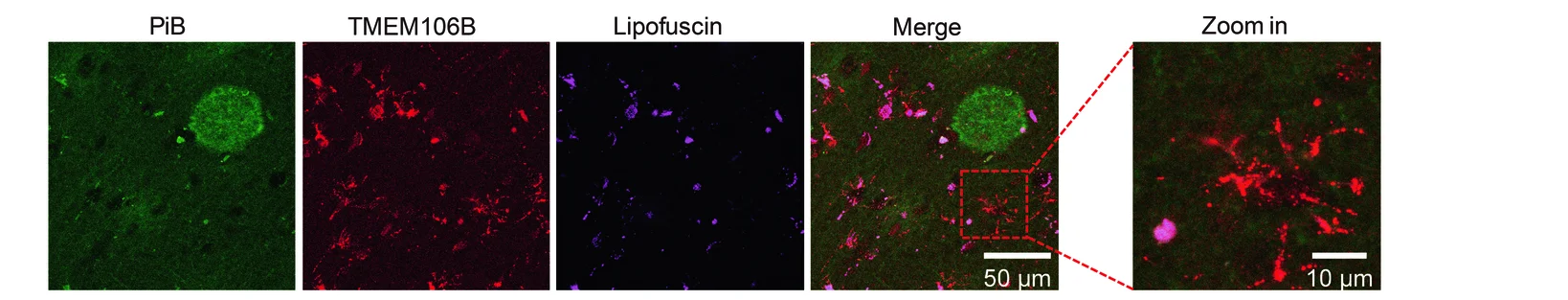 Open access visualization of Microscopy, Anti-TMEM106B, PiB, TMEM106B, Lipofuscin