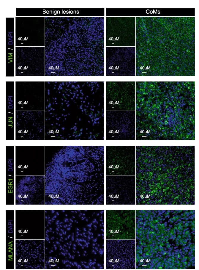 Open access visualization of Microscopy, IF Staining, FFPE Tissues, VIM Positive Cells, JUN Positive Cells