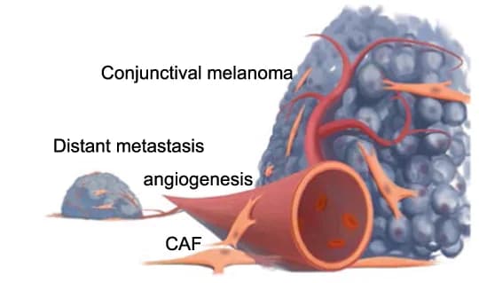 Open access visualization of Illustration, Schematic, CAFs, Metastasis, Angiogenesis
