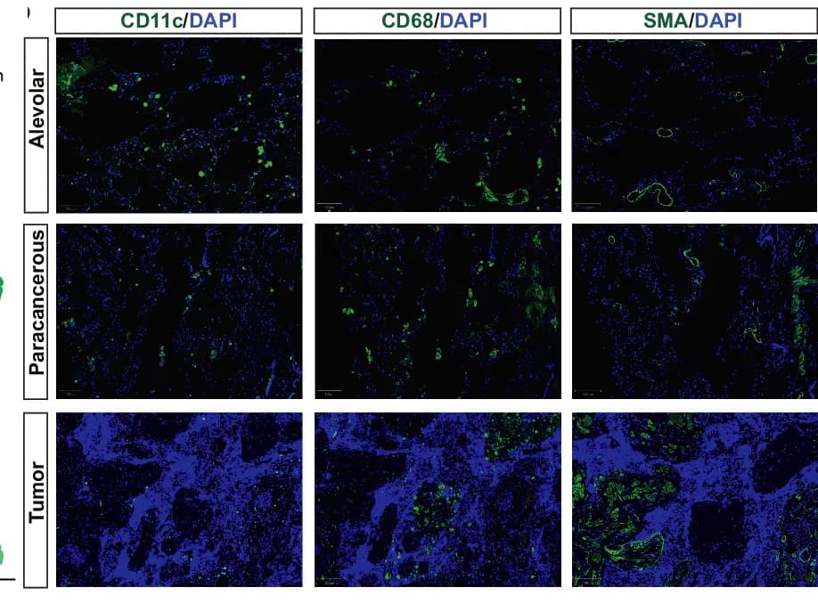 Open access visualization of Microscopy, Immunofluorescence Images, CD11c Monocytes, CD68 Macrophages, Tumor