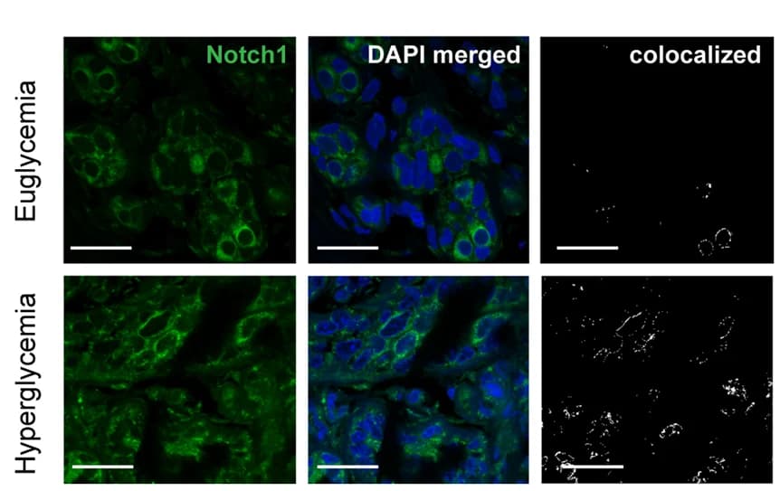 Open access visualization of Microscopy, Immunofluorescence Staining, NOTCH1, Breast Tumor Tissue Samples, HER2-positive Breast Cancer Patients