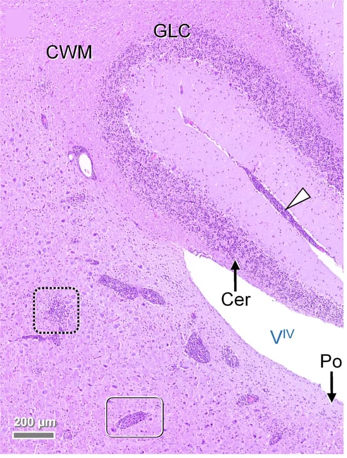 Open access visualization of Microscopy, Histology, Polio-predominant perivascular lymphohistiocytic cuffs, Angiocentric infiltrates, Brain Stem