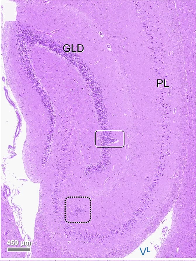 Open access visualization of Microscopy, Histology, Polio-predominant perivascular lymphohistiocytic cuffs, Angiocentric infiltrates, Hippocampus Formation