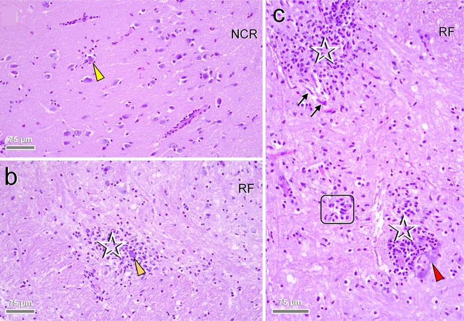 Open access visualization of Microscopy, Infected Brain, Neurons, Degenerative Features, Neuronophagia