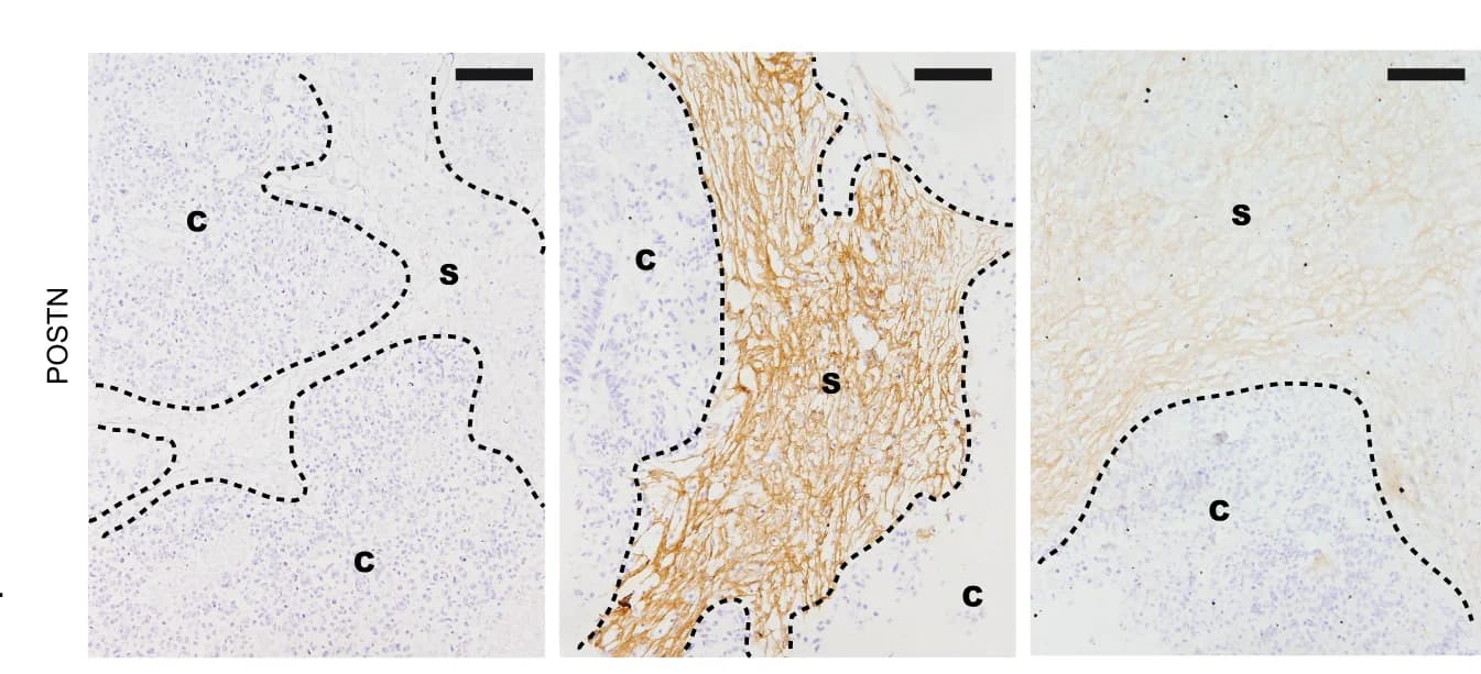 Open access visualization of Microscopy, Immunostaining, POSTN, Tumor Explants, Cancer