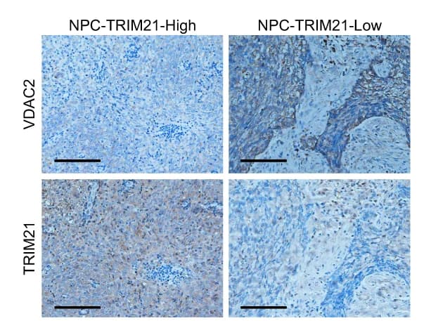 Open access visualization of Microscopy, TRIM21, VDAC2, IHC staining, NPC Tumor Tissues