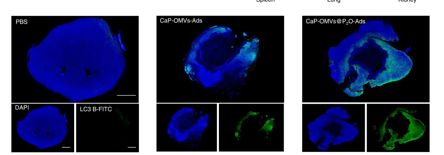 Open access visualization of Microscopy, Immunofluorescence, LC3 autophagic proteins, Tumor tissues, Tumor Cells