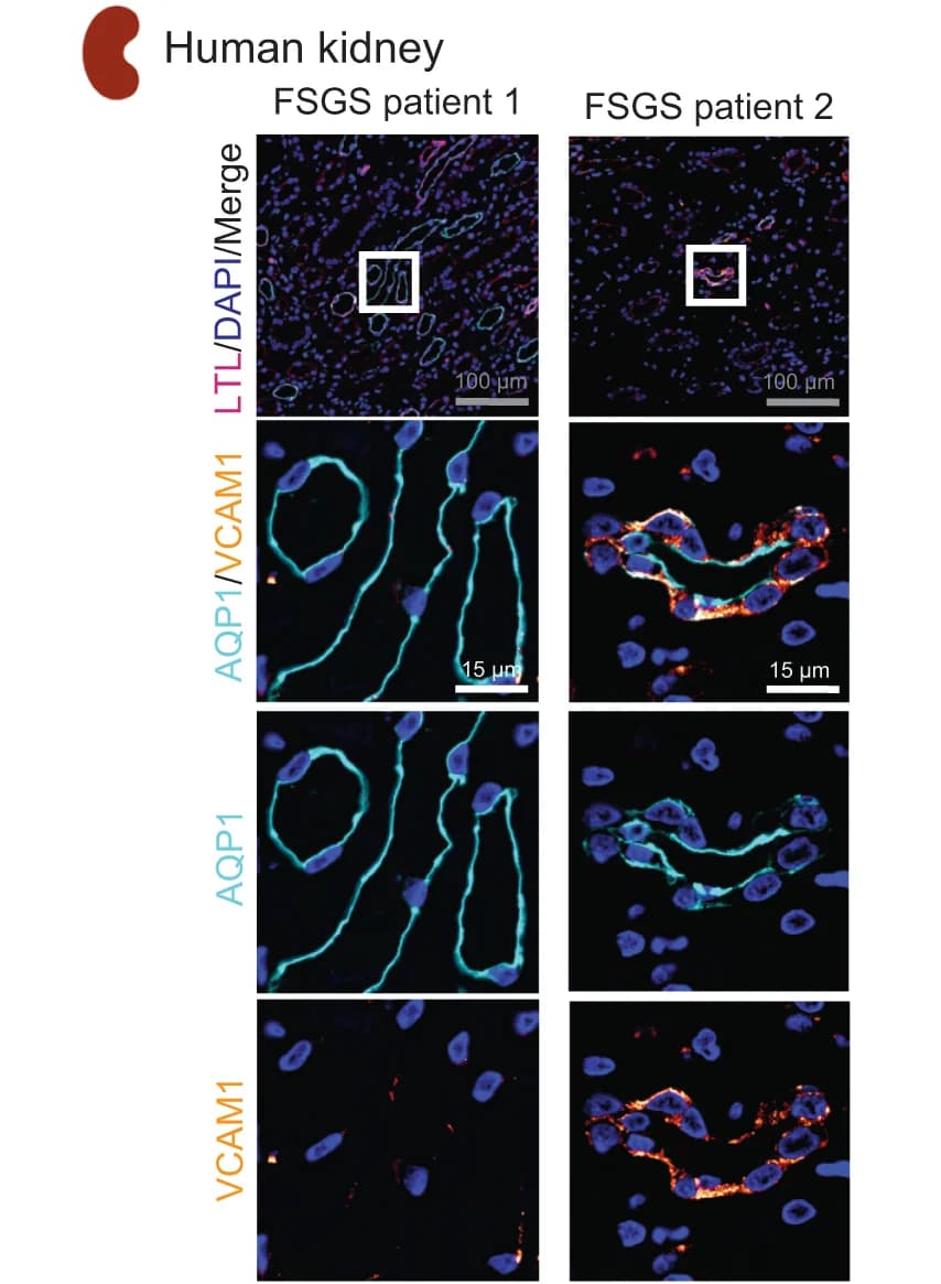 Open access visualization of Microscopy, Immunofluorescence Imaging, Human Kidney Biopsies, FSGS, VCAM1