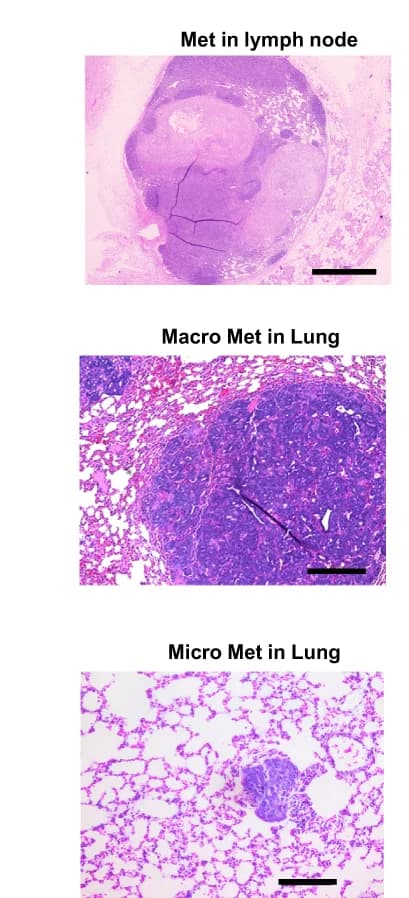 Open access visualization of Microscopy, Photo, H&E Staining, Lymph Node Metastases, Lung Metastases