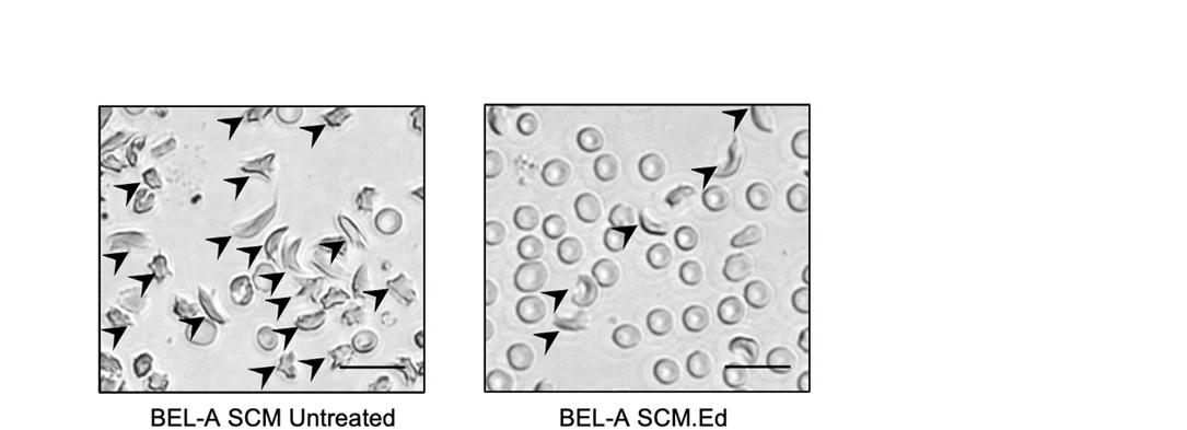 Open access visualization of Microscopy, Microscopic Images, Sickling, BEL-A SCM Cells, HBG1/2 Promoter Editing