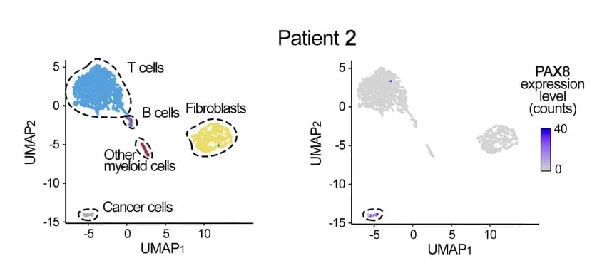 Open access visualization of UMAP, Scatter Plot, PAX8 Marker, Tumor Cells, Cell Populations