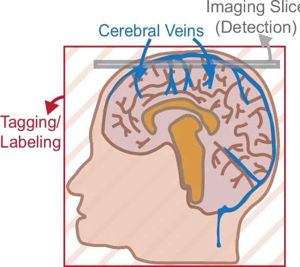 Open access visualization of Illustration, Cerebral System, Veins, Superior Sagittal Sinus, Tagging