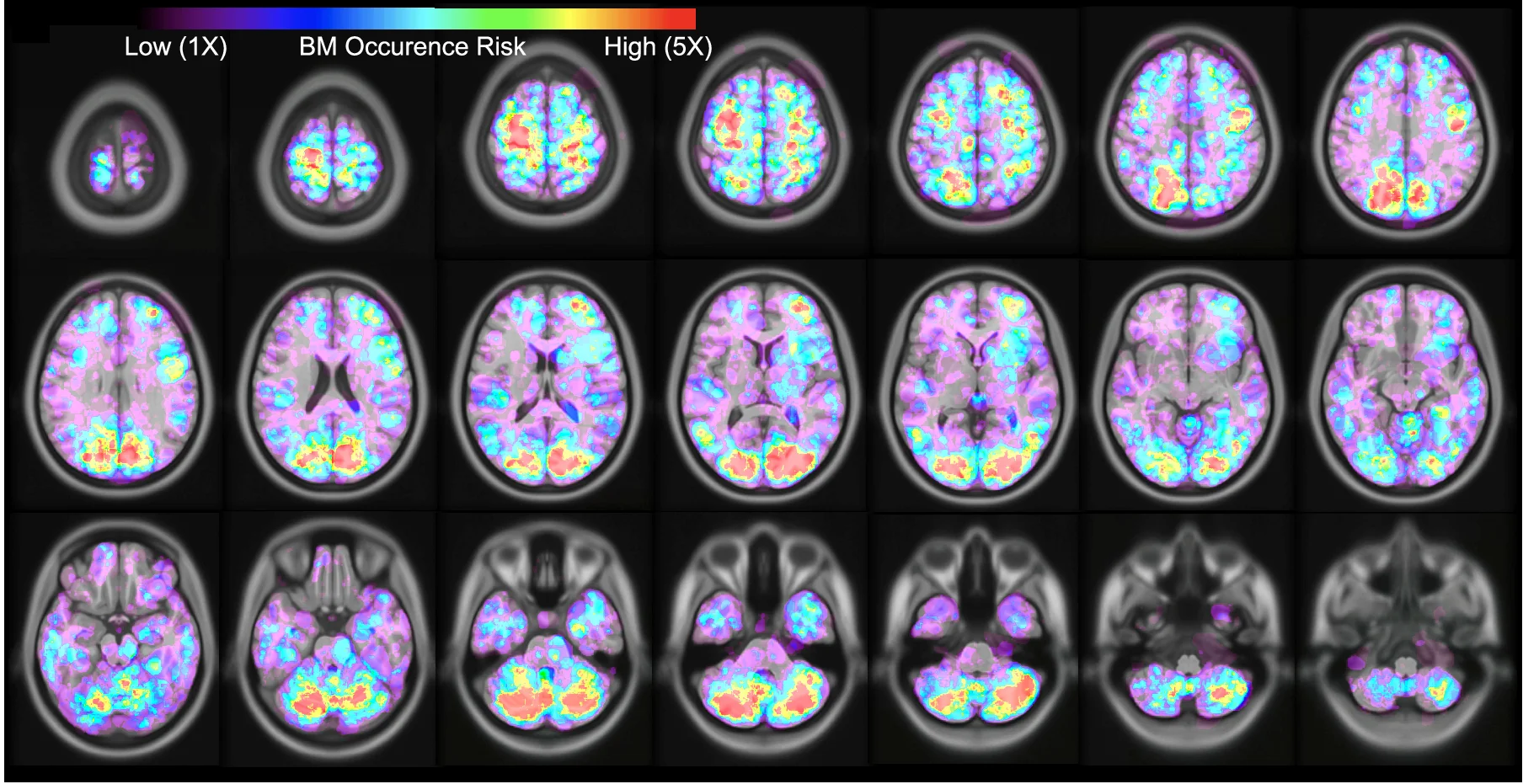 Open access visualization of Microscopy, Brain Metastasis, Risk Levels, Lung Cancer, MNI Model