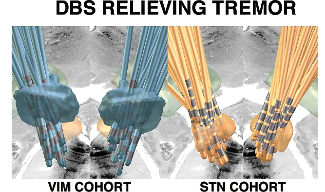 Open access visualization of 3D Plot, Protein Structure, Electrode Localization, VIM Patients, STN Patients