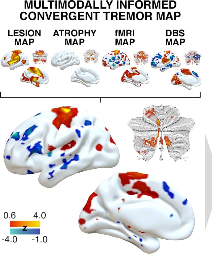 Open access visualization of 3D Plot, Lesion-Derived Map, EMG-fMRI-Derived Map, VIM-STN Map, ET-Specific Atrophy Map