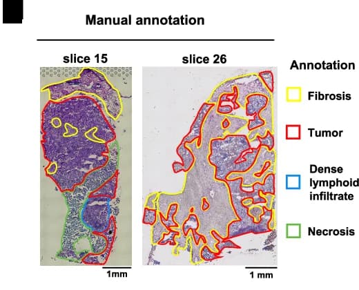 Open access visualization of Microscopy, Kaplan-Meier Survival Curve, Breast Cancer, Survival Analysis, Log-Rank Test