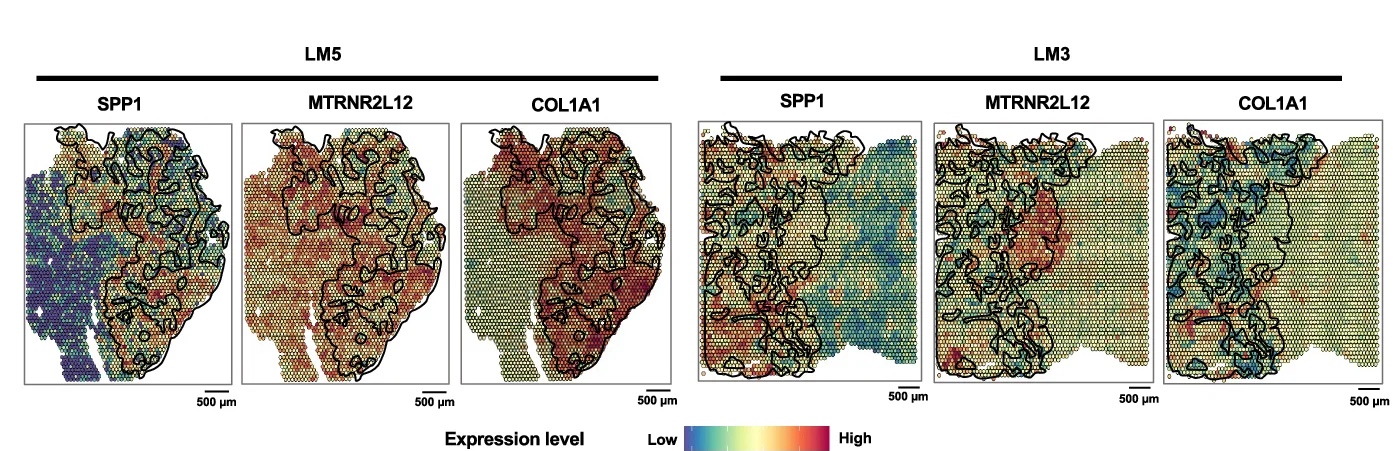 Open access visualization of Scatter Plot, Heatmap, Spatial Expression, Representative Genes, Metastasis-Related Cells