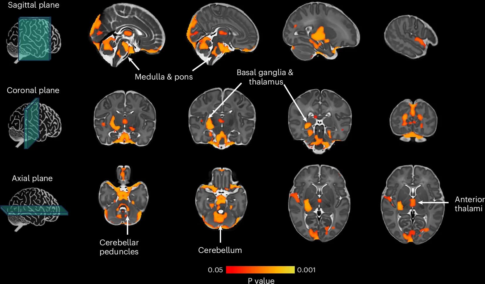 Open access visualization of Heatmap, t-statistic image, Brain, Voxel, Motor Control