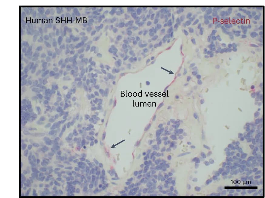 Open access visualization of Microscopy, Human, SHH-MB, Tumor Tissue, Immunostaining