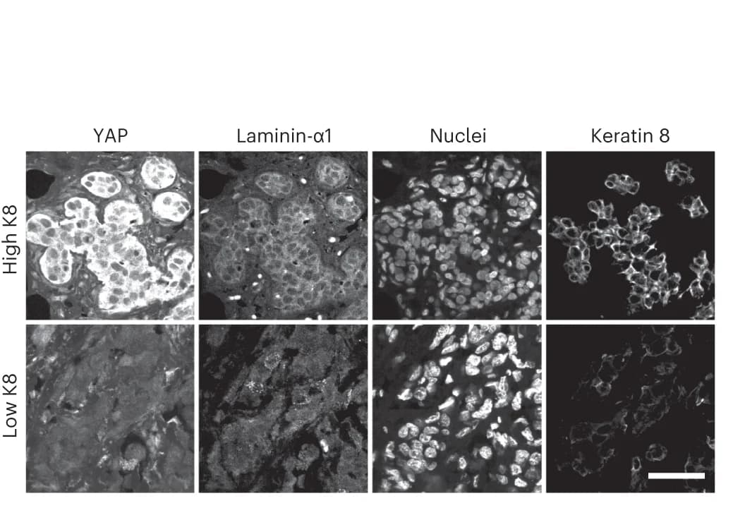 Open access visualization of Microscopy, Tissue Sections, Breast Cancer, Tumor Samples, Keratin 8