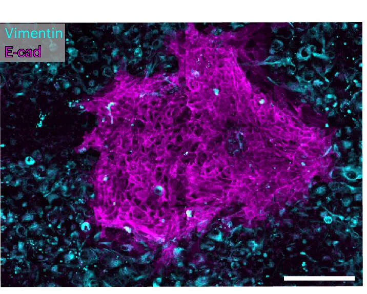 Open access visualization of Microscopy, Metaplastic Cancer Cells, E-cad, Vimentin