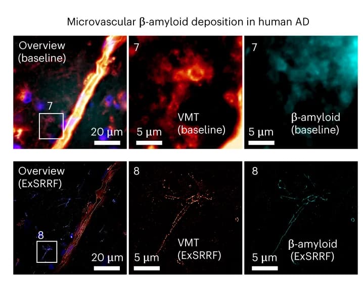 Open access visualization of Microscopy, Microvascular β-amyloid deposition, Human brain tissue, Alzheimer's Disease, Vimentin