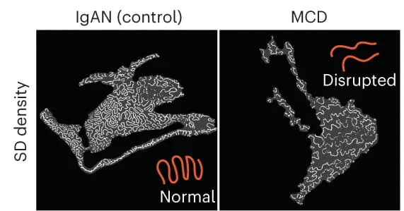 Open access visualization of Microscopy, Image Analysis, Nanoscale Morphometrics, Slit Diaphragm Density, Immunoglobulin A Nephropathy