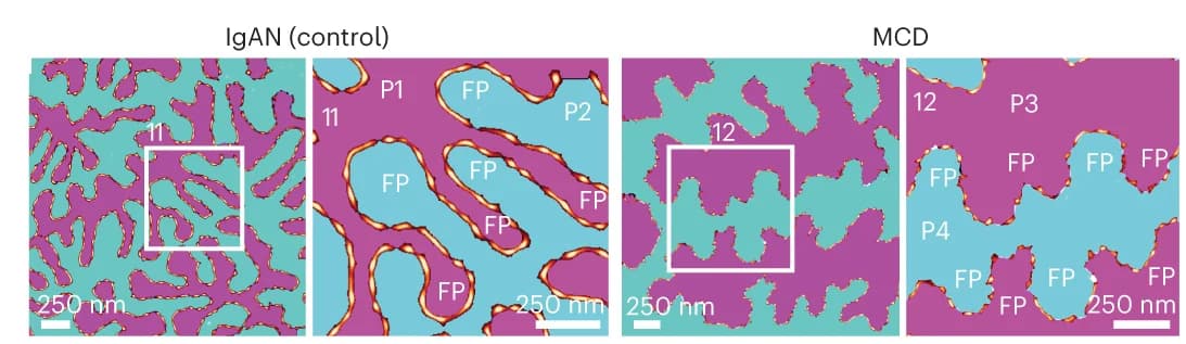 Open access visualization of Microscopy, ExSRRF, Scanning Electron Micrographs, Podocytes, Immunoglobulin A Nephropathy
