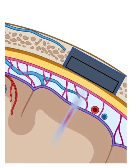 Open access visualization of Illustration, Visual Restoration, US Matrix Arrays, Cranial Window, US Neuromodulation