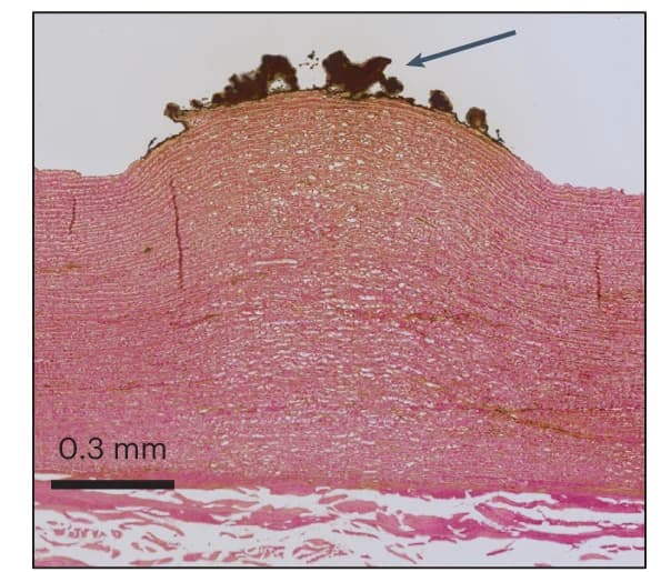 Open access visualization of Microscopy, Histological Section, Blood Adhesion, Intimal Surface