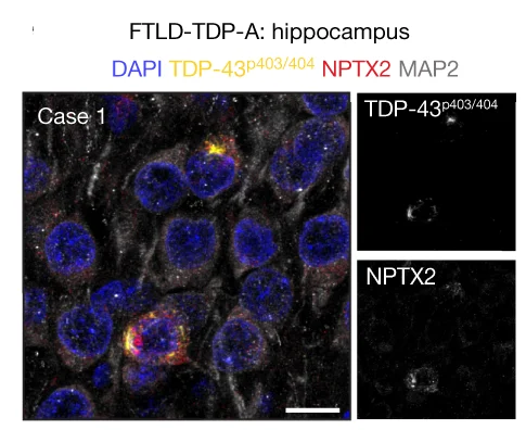 Open access visualization of Microscopy, Immunofluorescence, Human Brain Sections, FTLD-TDP-A, Hippocampus
