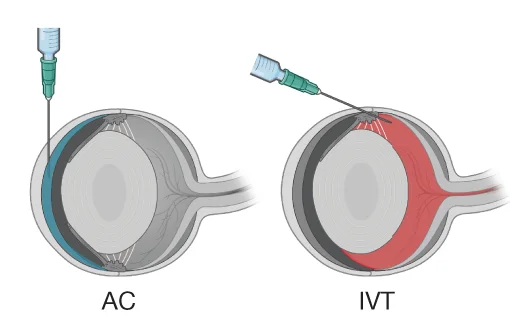 Open access visualization of Illustration, AC Injection, IVT Injection, Dye
