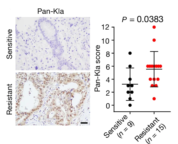 Open access visualization of Scatter Plot, IHC Staining, Pan-Kla Antibody, Tumor Specimens, Gastric Cancer