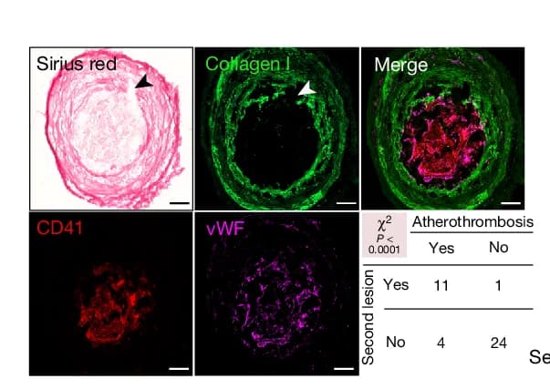 Open access visualization of Microscopy, Table Image, Plaque Rupture, Sirius Red Staining, Collagen I Staining