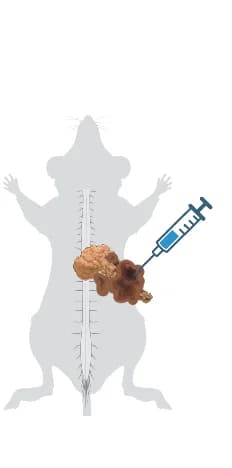 Open access visualization of Illustration, Intrapancreatic Melanoma, Schematic
