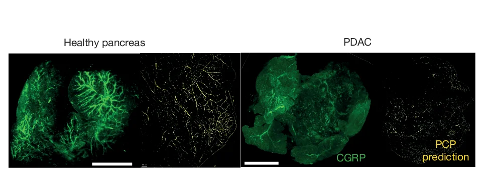 Open access visualization of Microscopy, LSFM Images, Pancreas, PDAC, CGRP