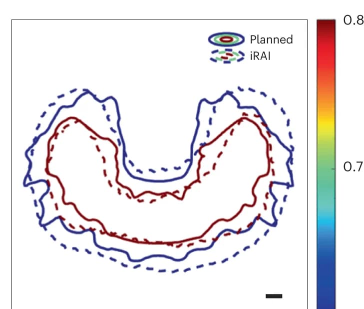 Open access visualization of Line Plot, Isodose Lines, Planned Dose Distribution, iRAI Imaged Relative Dose Distribution
