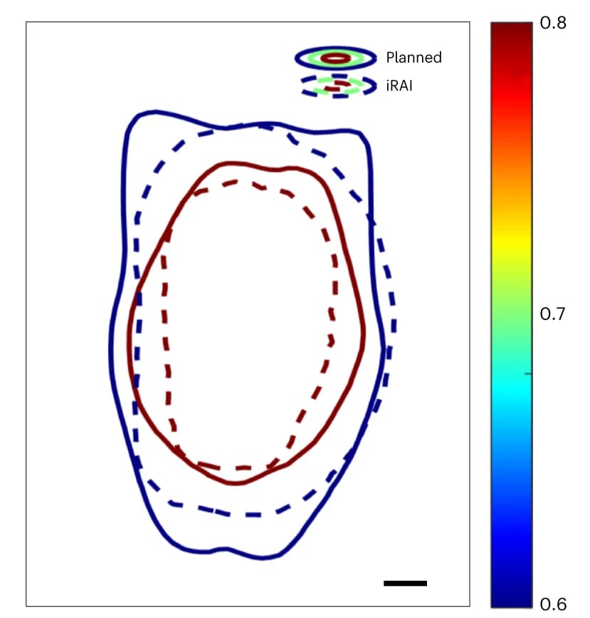 Open access visualization of Line Plot, Isodose Lines, iRAI Measurement, Treatment Plan, Front Edge