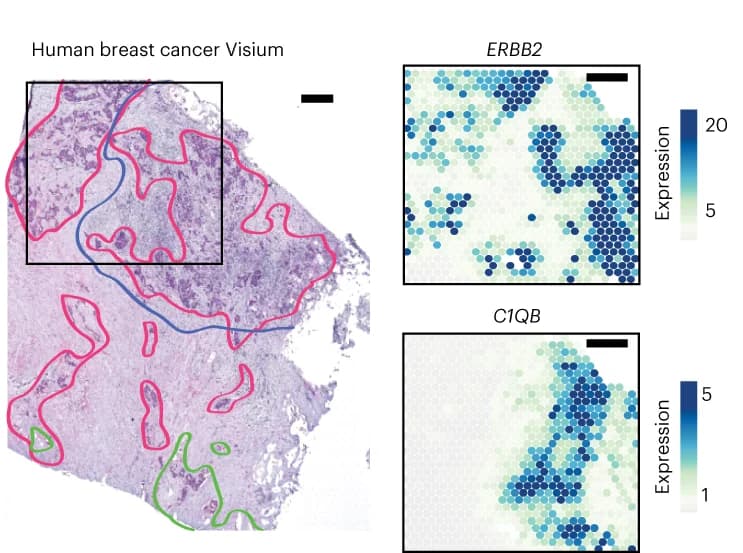 Open access visualization of Microscopy, Heatmap, Hematoxylin and eosin, Breast Cancer, Visium
