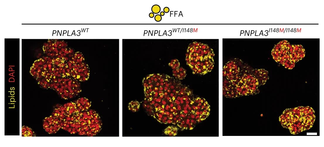 Open access visualization of Microscopy, Nile Red Lipid Staining, FFA-exposed, PNPLA3 Variant Organoids