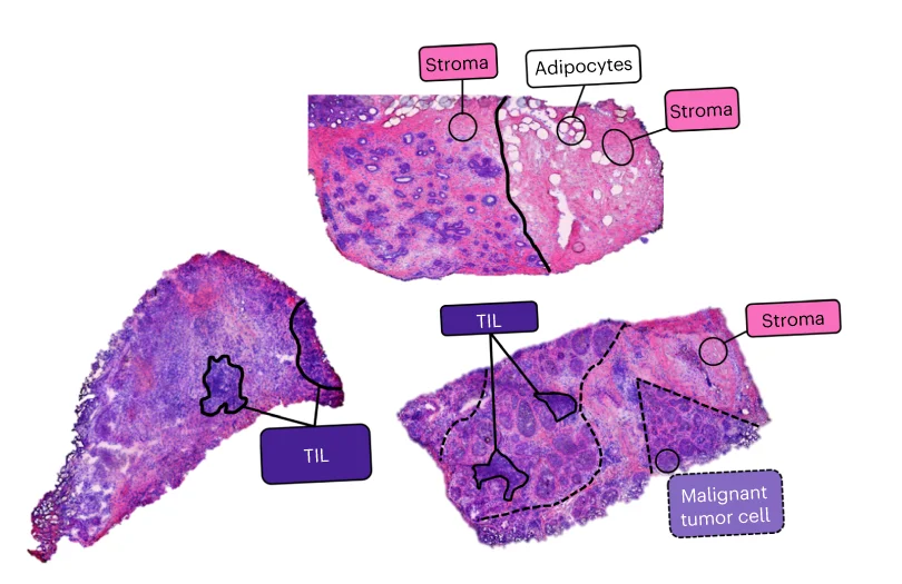 Open access visualization of Microscopy, Photo, Pathological Histology, TNBC, Hubs