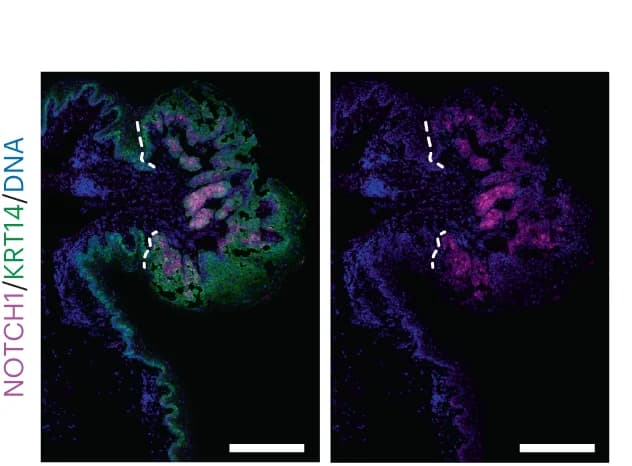 Open access visualization of Microscopy, NOTCH1 staining, KRT14 staining, Tumors, Tissue