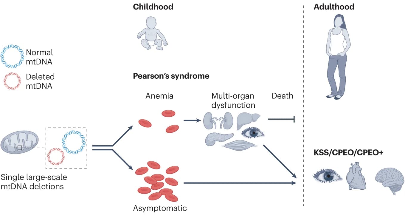 Open access visualization of Workflow, Flowchart, Illustration, mtDNA Deletions, Pearson’s Syndrome